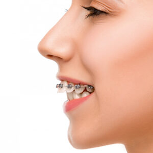 Orthodontic problem