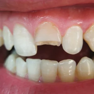 Dental Emergencies