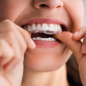 Clear Aligners
