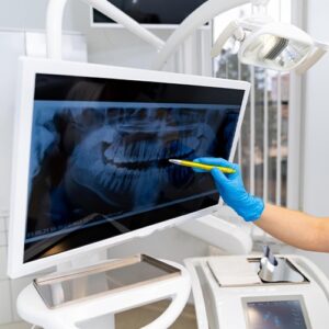painless root canal